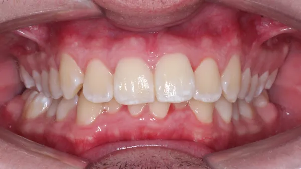 Caso 01 brackets · antes