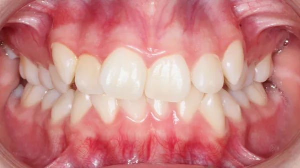 Caso 02 brackets · antes