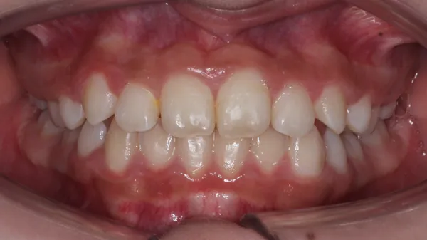 Caso 03 brackets · después