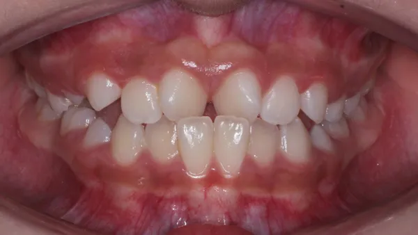 Caso 03 brackets · antes