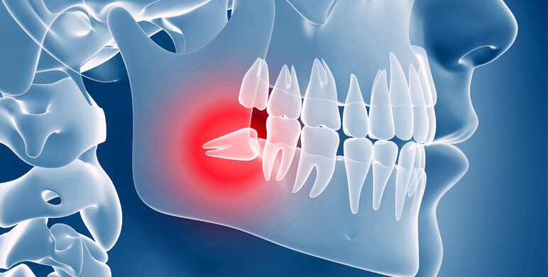 Tercero Molar